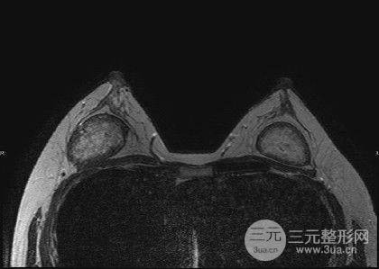 丰胸失败的吓人图片