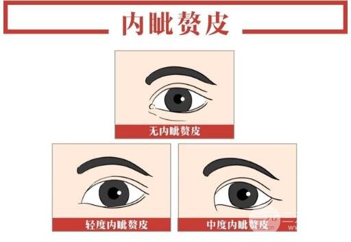 什么样的人群适合开内眼角呢?