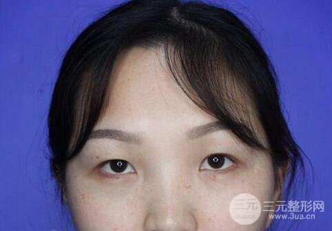 开眼角案例