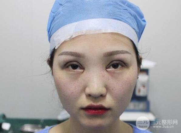 开眼角案例