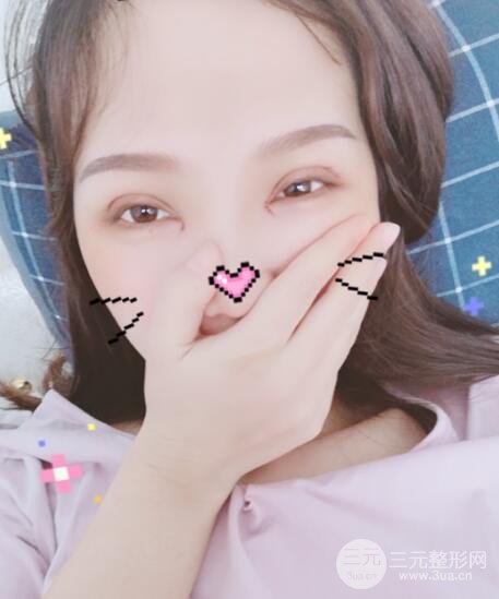 开眼角案例