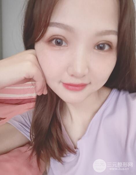 开眼角案例