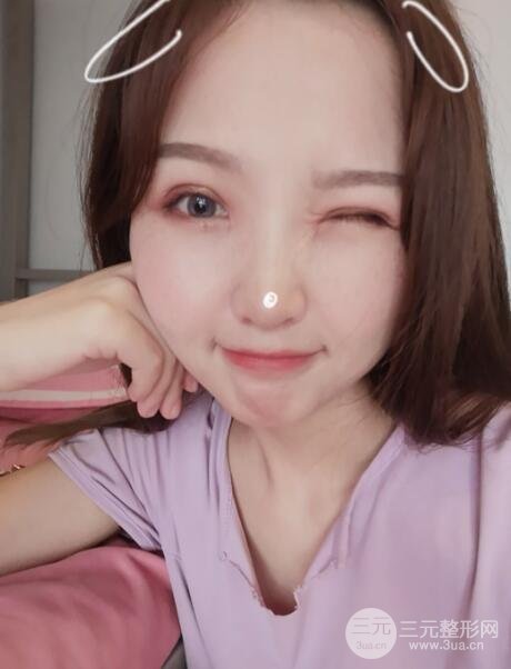 开眼角案例