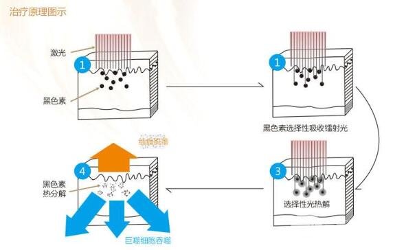 激光洗眉原理