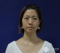 埋线双眼皮20年后图片，看过之后可能你就想做了！
