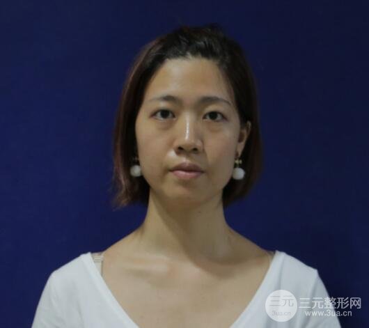 埋线双眼皮20年后图片，看过之后可能你就想做了！