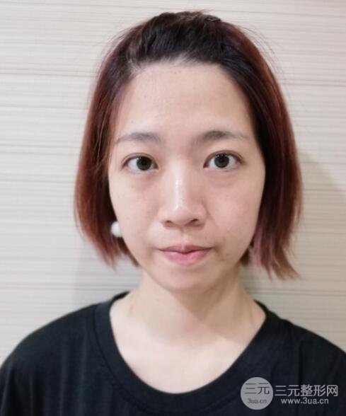 埋线双眼皮20年后图片，看过之后可能你就想做了！