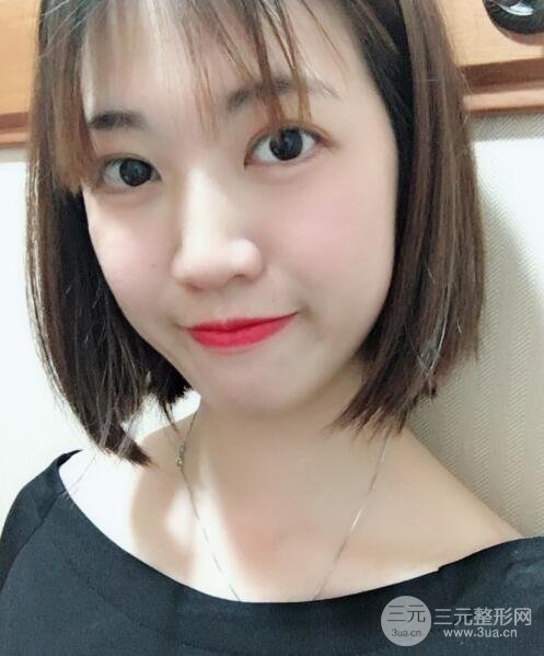 埋线双眼皮20年后图片，看过之后可能你就想做了！