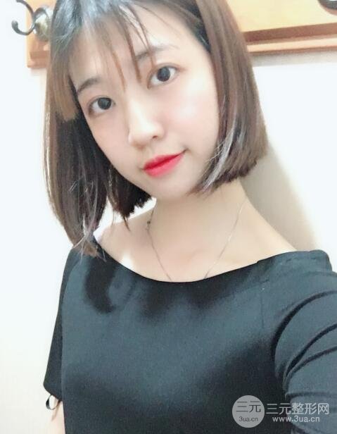埋线双眼皮20年后图片，看过之后可能你就想做了！