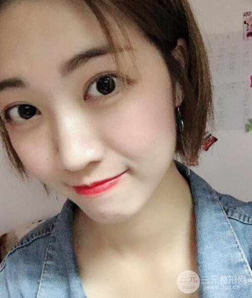 埋线双眼皮20年后图片，看过之后可能你就想做了！