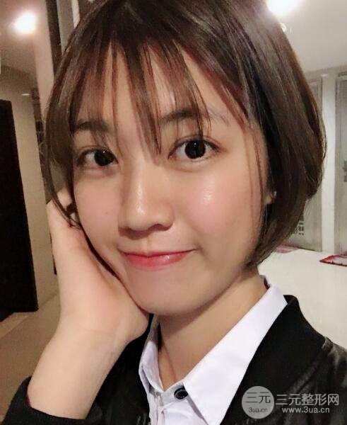 埋线双眼皮20年后图片，看过之后可能你就想做了！