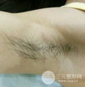 脱腋毛果图片真人恢复过程记录，浓重体毛轻松摆脱！