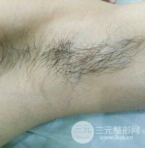 脱腋毛果图片真人恢复过程记录,浓重体毛轻松摆脱!