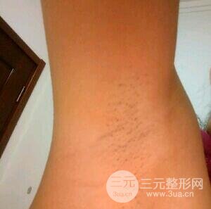 脱腋毛果图片真人恢复过程记录,浓重体毛轻松摆脱!
