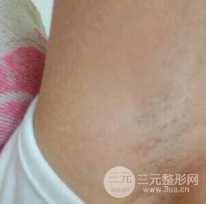 脱腋毛果图片真人恢复过程记录,浓重体毛轻松摆脱!