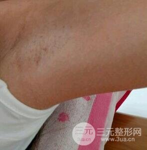 脱腋毛果图片真人恢复过程记录,浓重体毛轻松摆脱!
