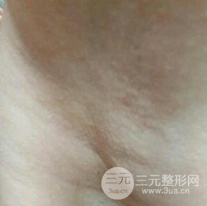 脱腋毛果图片真人恢复过程记录,浓重体毛轻松摆脱!