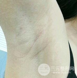 脱腋毛果图片真人恢复过程记录,浓重体毛轻松摆脱!