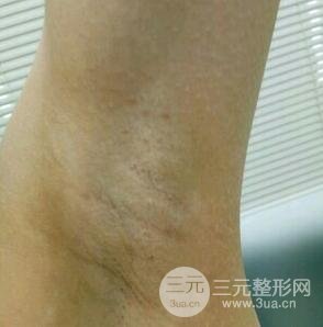 脱腋毛果图片真人恢复过程记录,浓重体毛轻松摆脱!