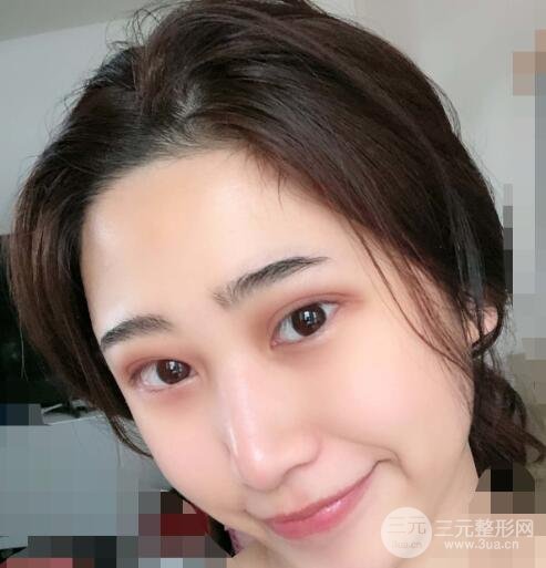 双眼皮恢复过程图真人记录，告别小眼睛之旅~