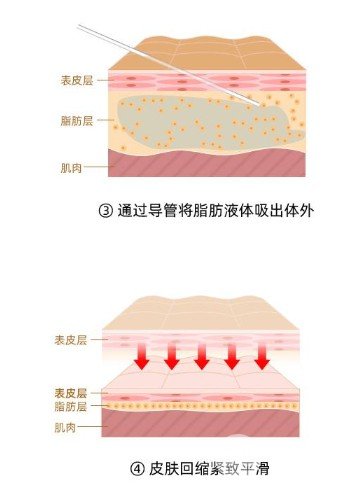 吸脂减肥术术后护理要点