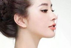 下巴短整形要怎么做？假体垫下巴案例