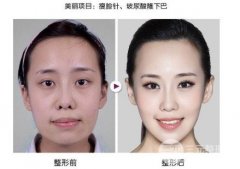 注射瘦脸多少一针？为什么你打了没用？