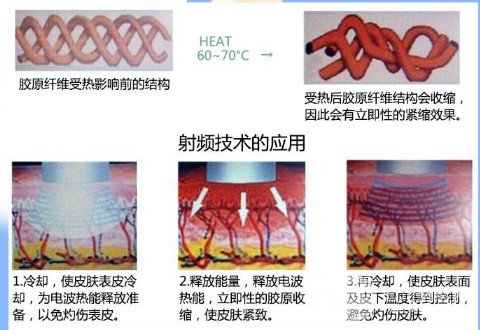 激光除皱果