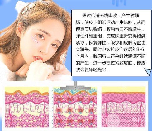 激光除皱果