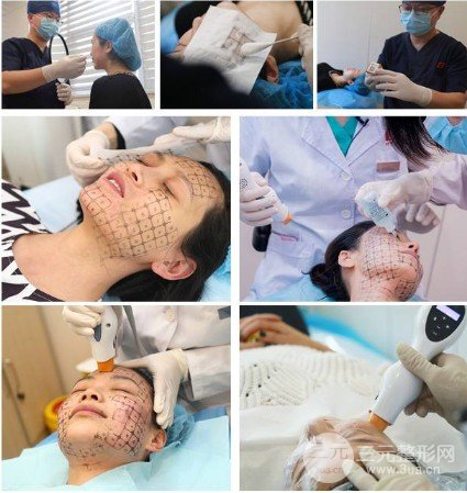 激光除皱果