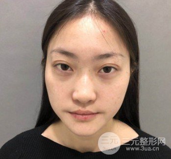 果酸换肤果真的好吗