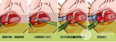 去颊脂垫手术后的恢复