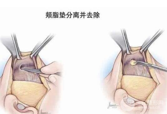 去颊脂垫手术的副作用