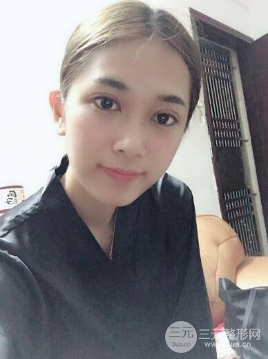 埋线双眼皮十天恢复图真人记录