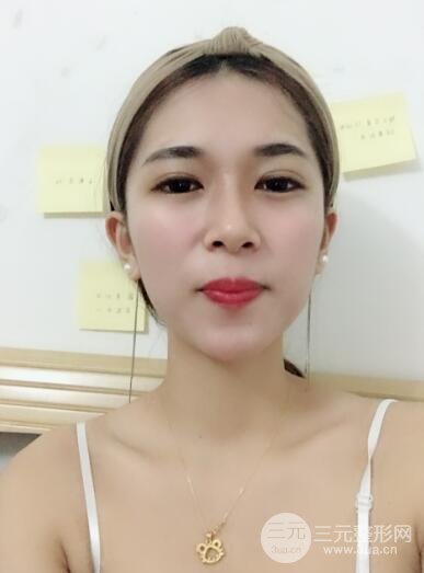 埋线双眼皮十天恢复图真人记录