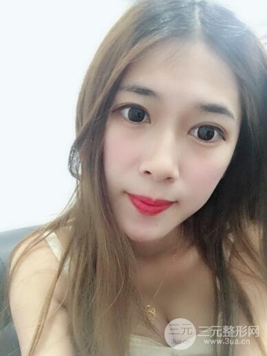 埋线双眼皮十天恢复图真人记录