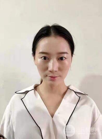 双眼埋线恢复七天图