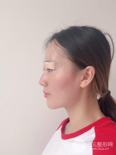 双眼埋线恢复七天图