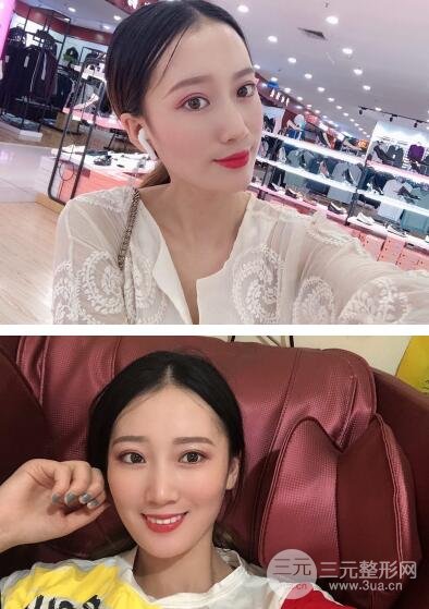 双眼埋线恢复七天图