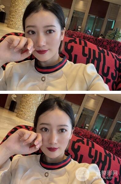 双眼埋线恢复七天图