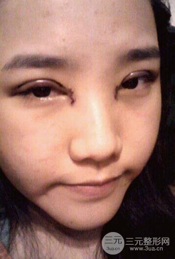 开眼角前后对比照片图