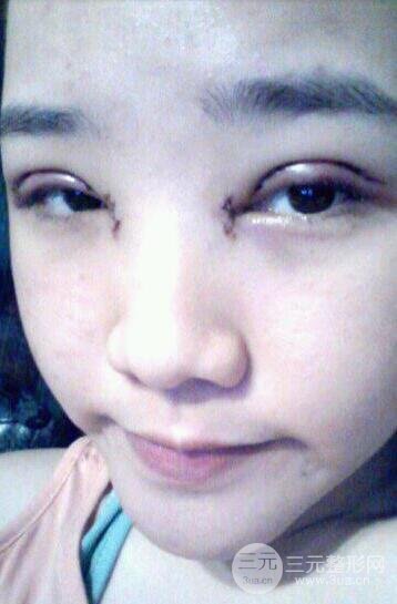 开眼角前后对比照片图