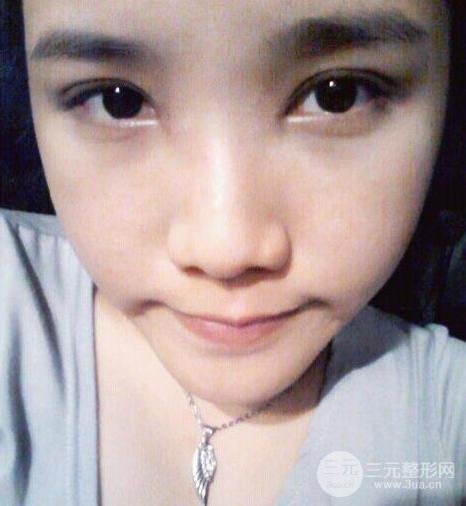 开眼角前后对比照片图