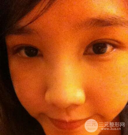 开眼角前后对比照片图