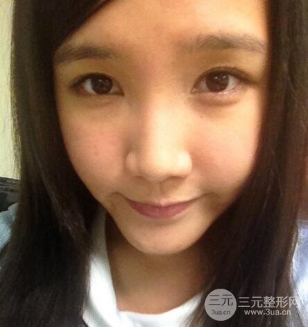 开眼角前后对比照片图