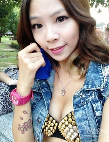 开眼角前后对比照片图