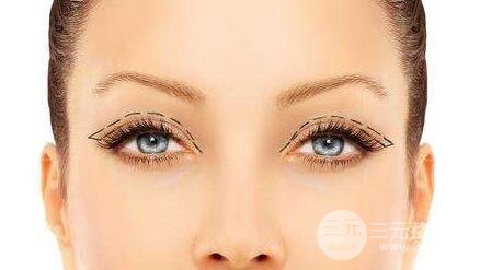 有必要同时做双眼皮和开眼角吗?