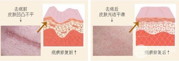 激光去疤过程