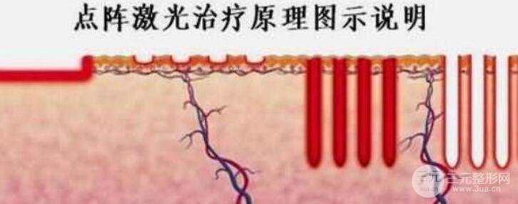 激光祛疤注意事项