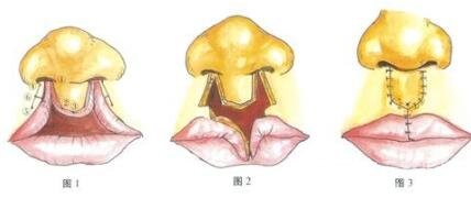 唇裂修复手术成好吗?